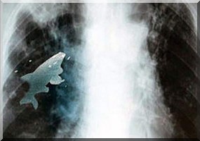 Un poisson vivant dans les poumons d'un enfant.