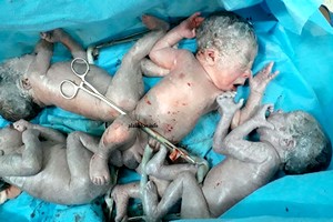 Nouakchott: naissance d’un quadruplé à l'hôpital national (vidéo)